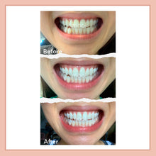 Load image into Gallery viewer, MOOI Teeth Whitening Kit with Free Pouch and Free Gift
